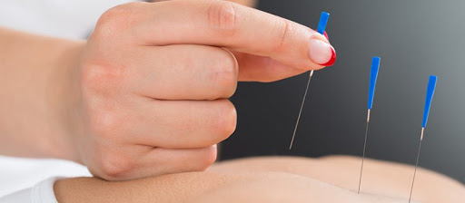 dry-needling-therapeutic-relieve-pain.jpg